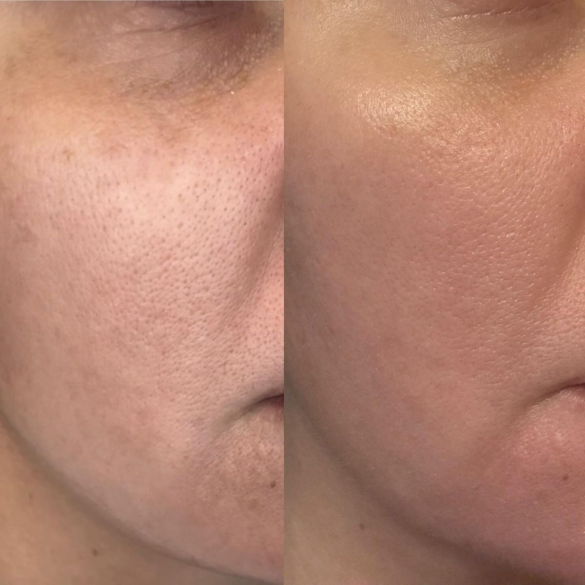 Résultats immédiats